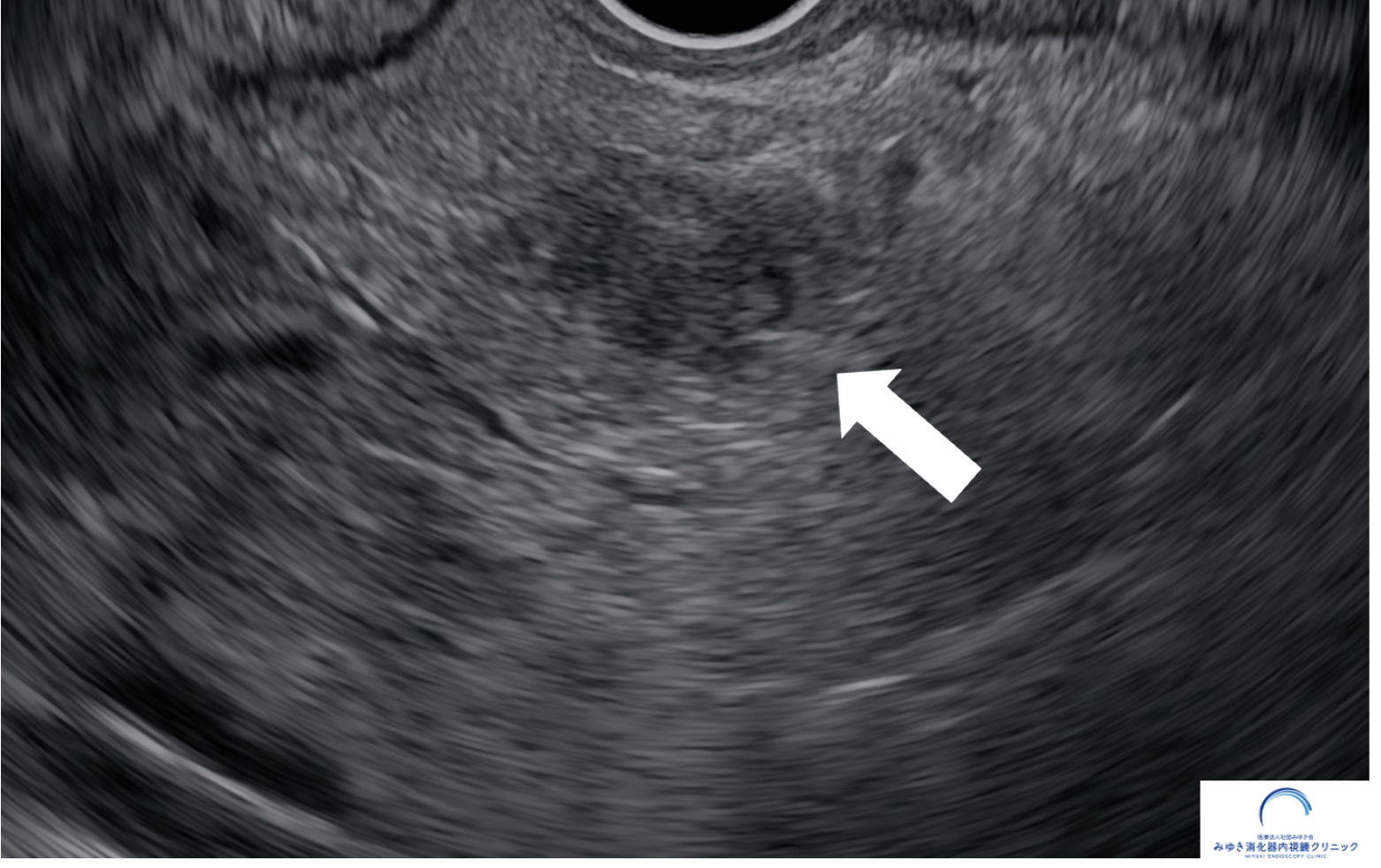 膵神経内分泌腫瘍を示した超音波内視鏡（EUS）画像 約10mmの腫瘤