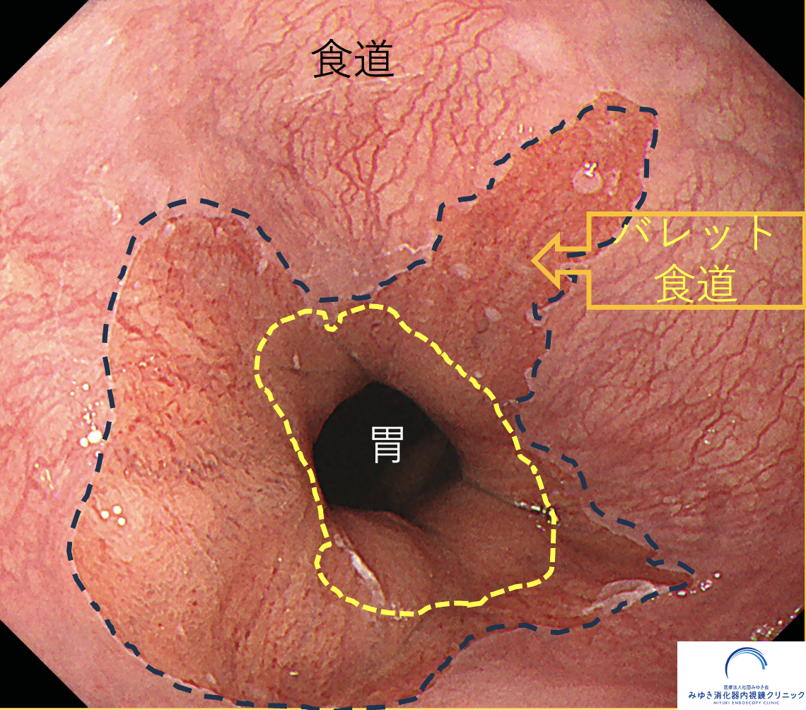 今月の1例：バレット食道