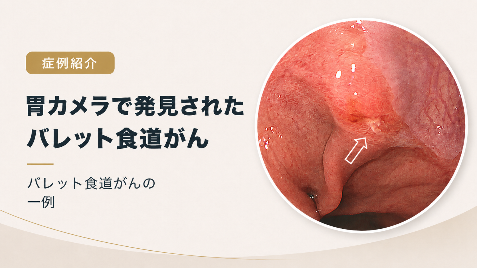 【症例】バレット食道がん