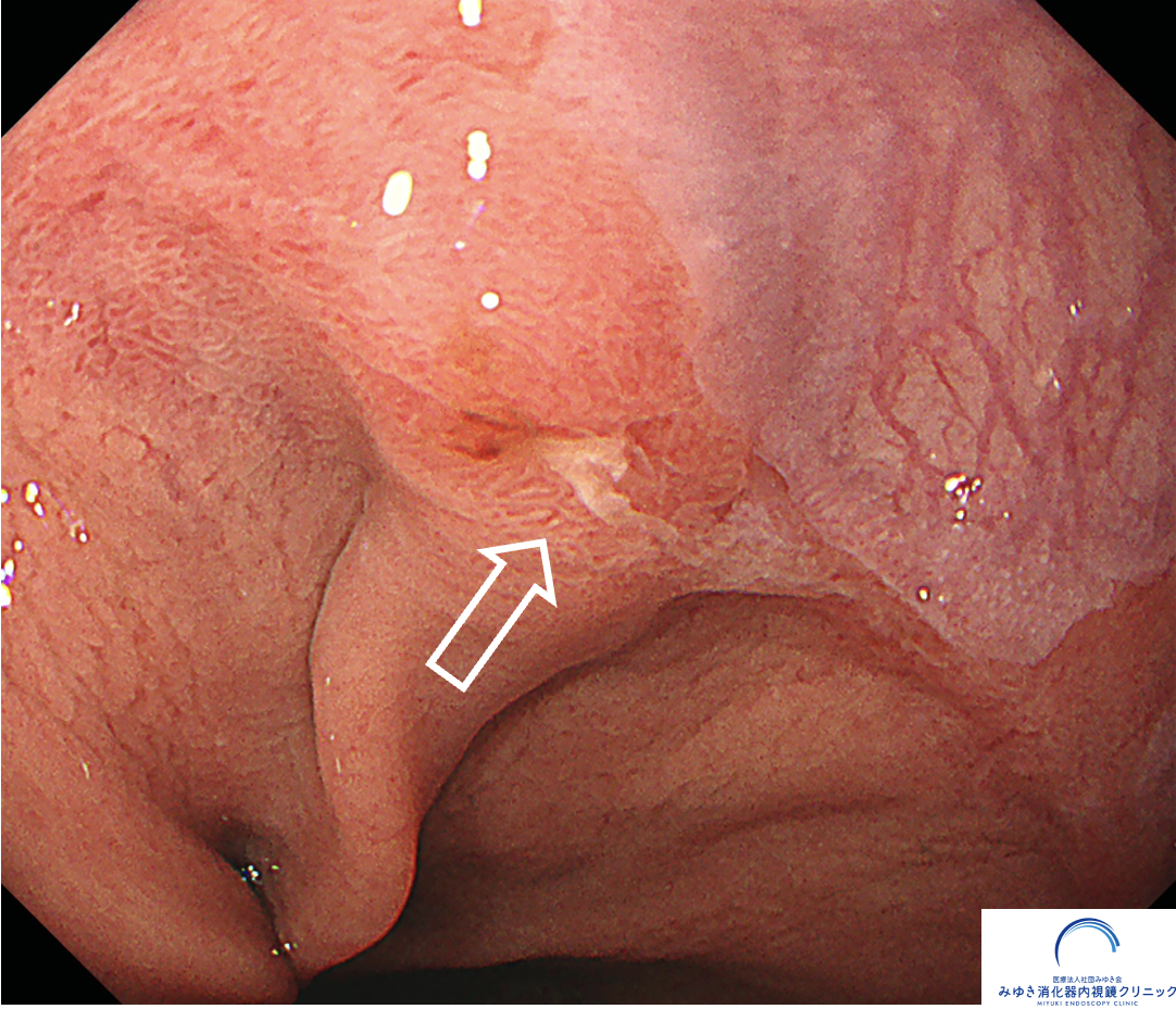 今月の1例：バレット食道がん
