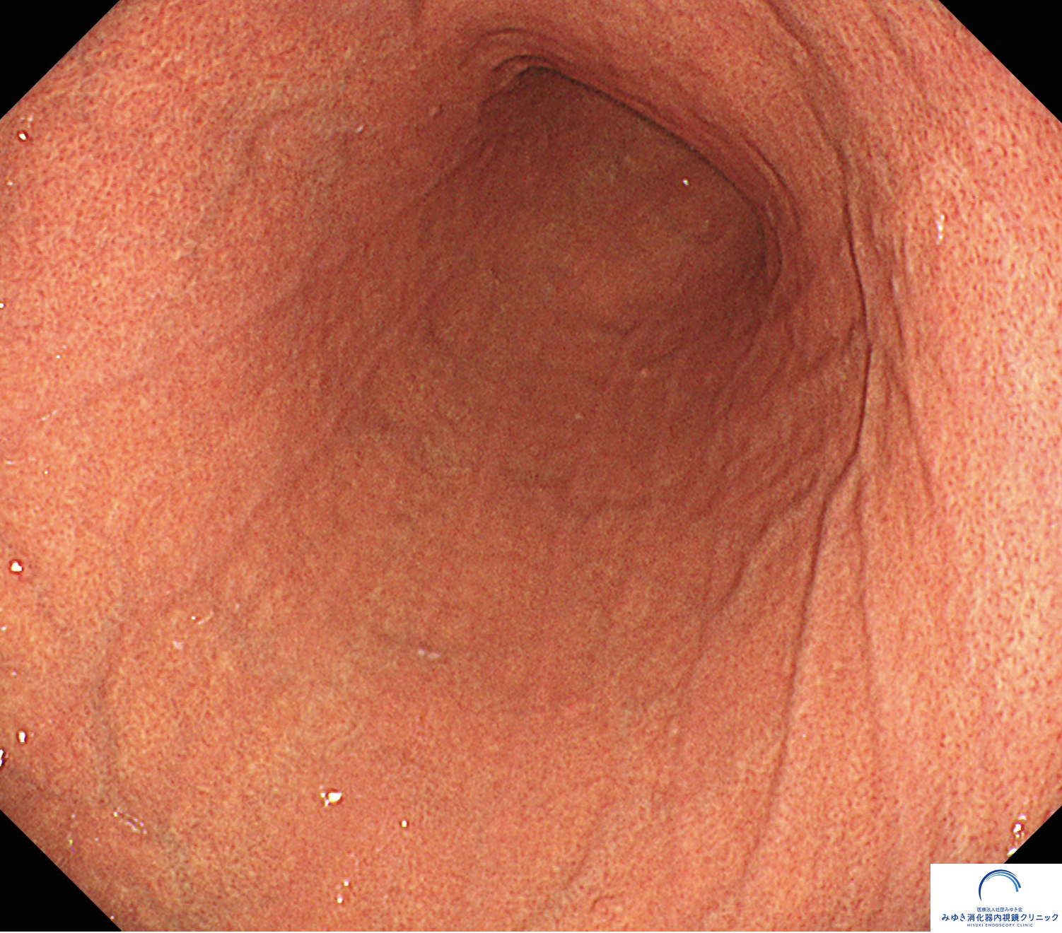 今月の1例：正常な胃