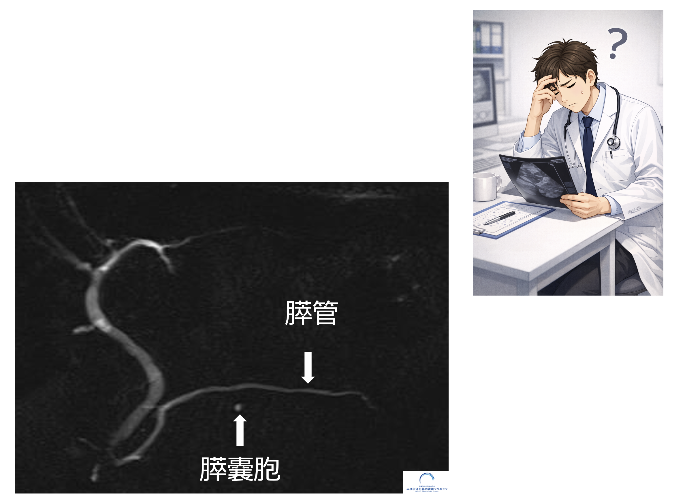 小さな膵嚢胞が見つかりました。どうすればよいですか？