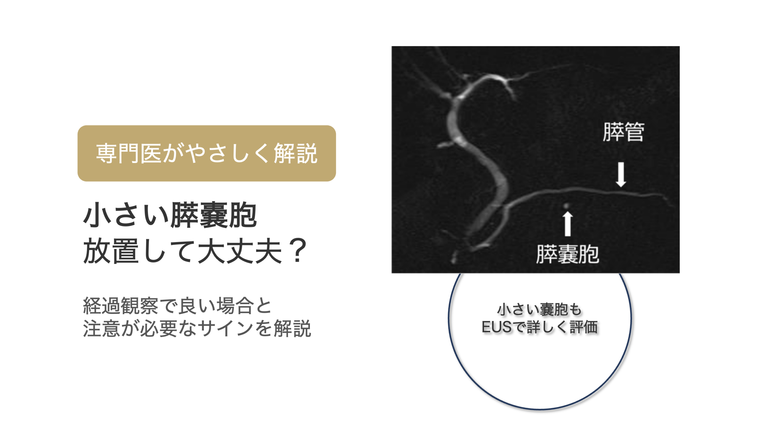 膵嚢胞が見つかったと言われたら｜小さな膵嚢胞の多くは心配ありません