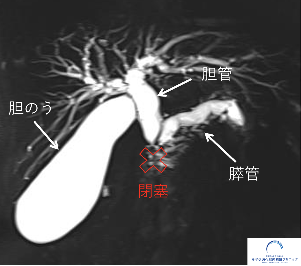 健康診断で「膵管拡張」と言われた方へ｜膵がんの可能性と今すぐ受けるべき検査