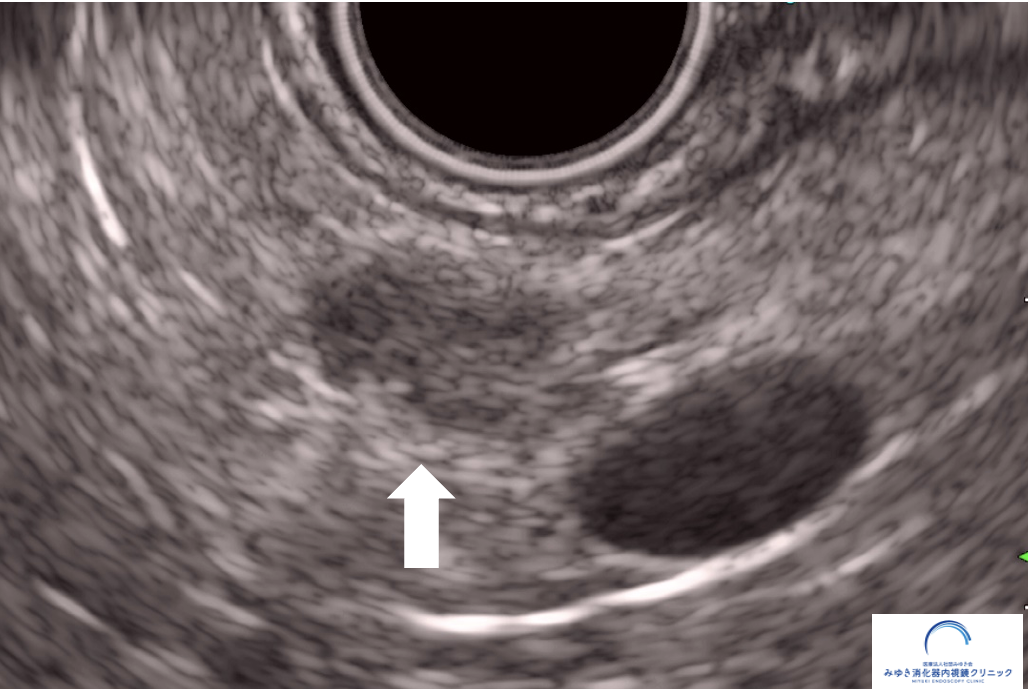 超音波内視鏡（EUS）で認めた膵臓腫瘍（約8mm）