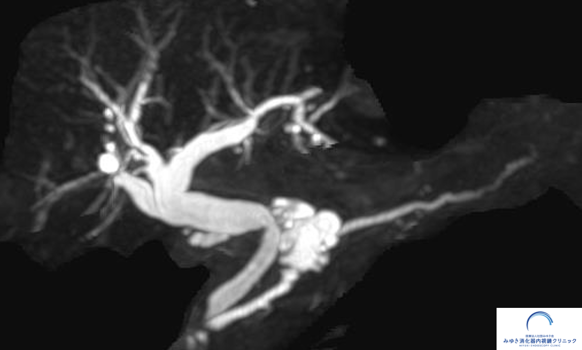 MRCPで描出された膵管と分枝型IPMNの嚢胞性病変の画像