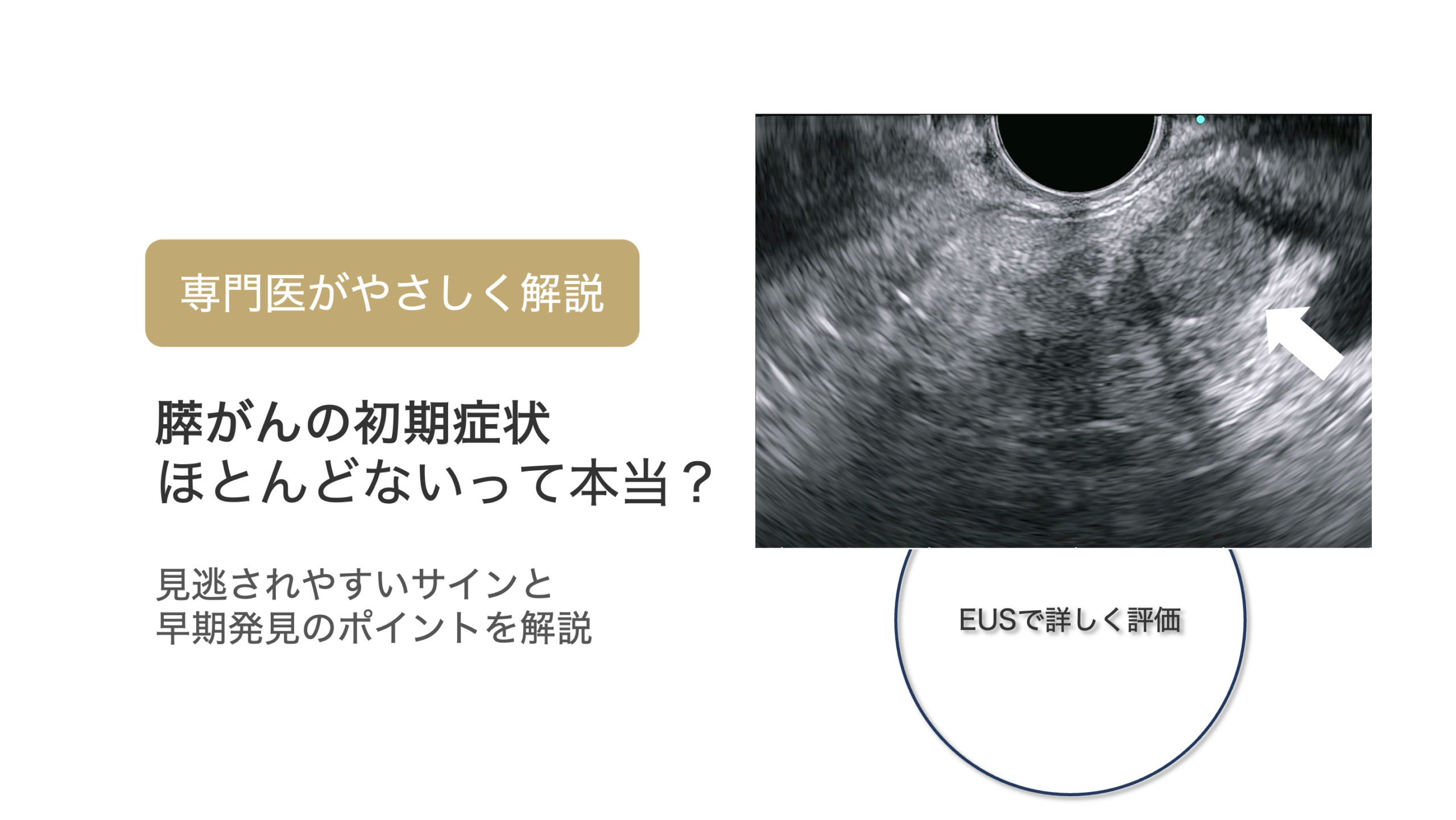 膵臓がんの初期症状｜見逃されやすい理由と早期発見のポイント