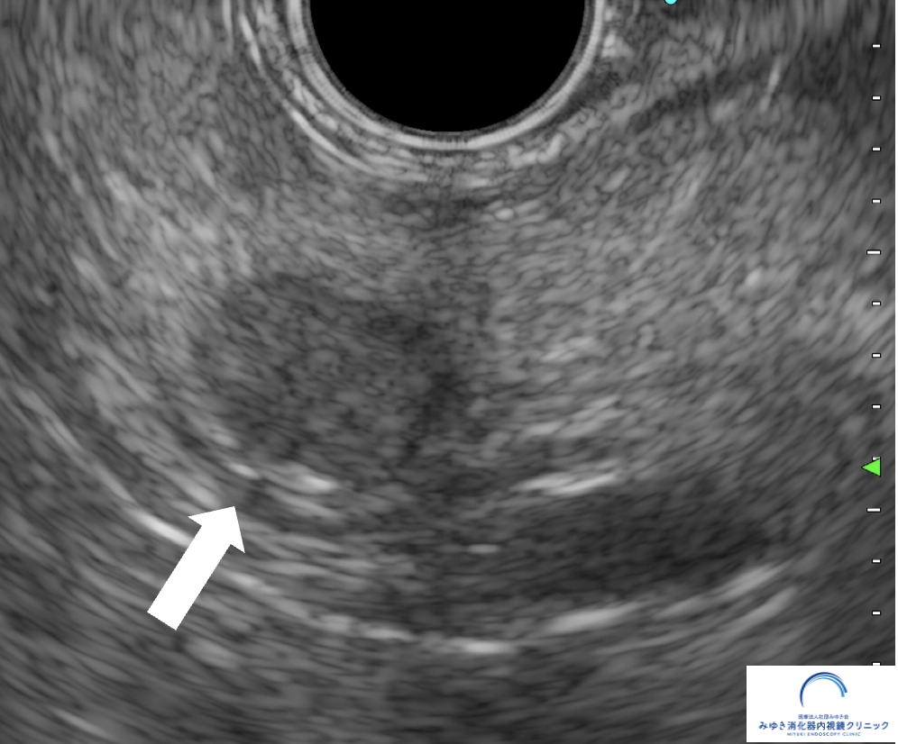 今月の1例：膵がんドックで発見された膵神経内分泌腫瘍（10mm）― MRIでは分からなかった膵腫瘍をEUSで発見 ―