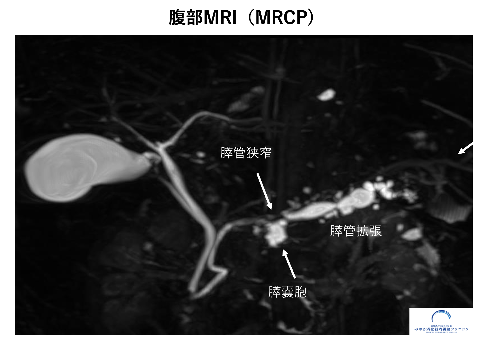 膵管拡張のイメージ図｜膵管が太くなる様子