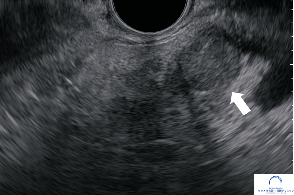 超音波内視鏡（EUS）で認めた膵臓腫瘍（約10mm）