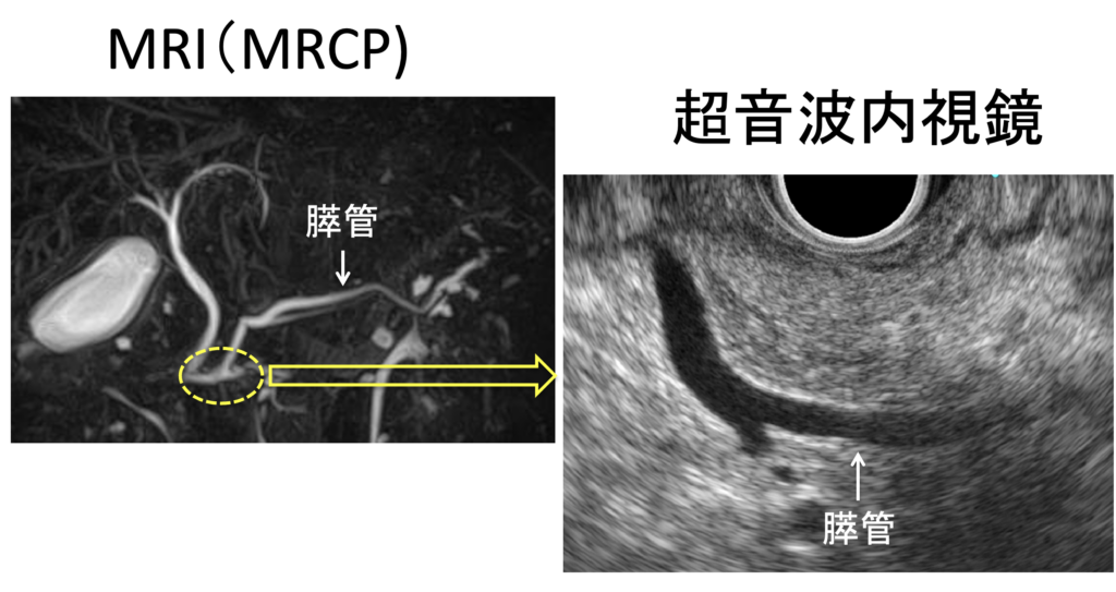 MRI(MRCP)と超音波内視鏡(EUS)で観察した膵管の画像