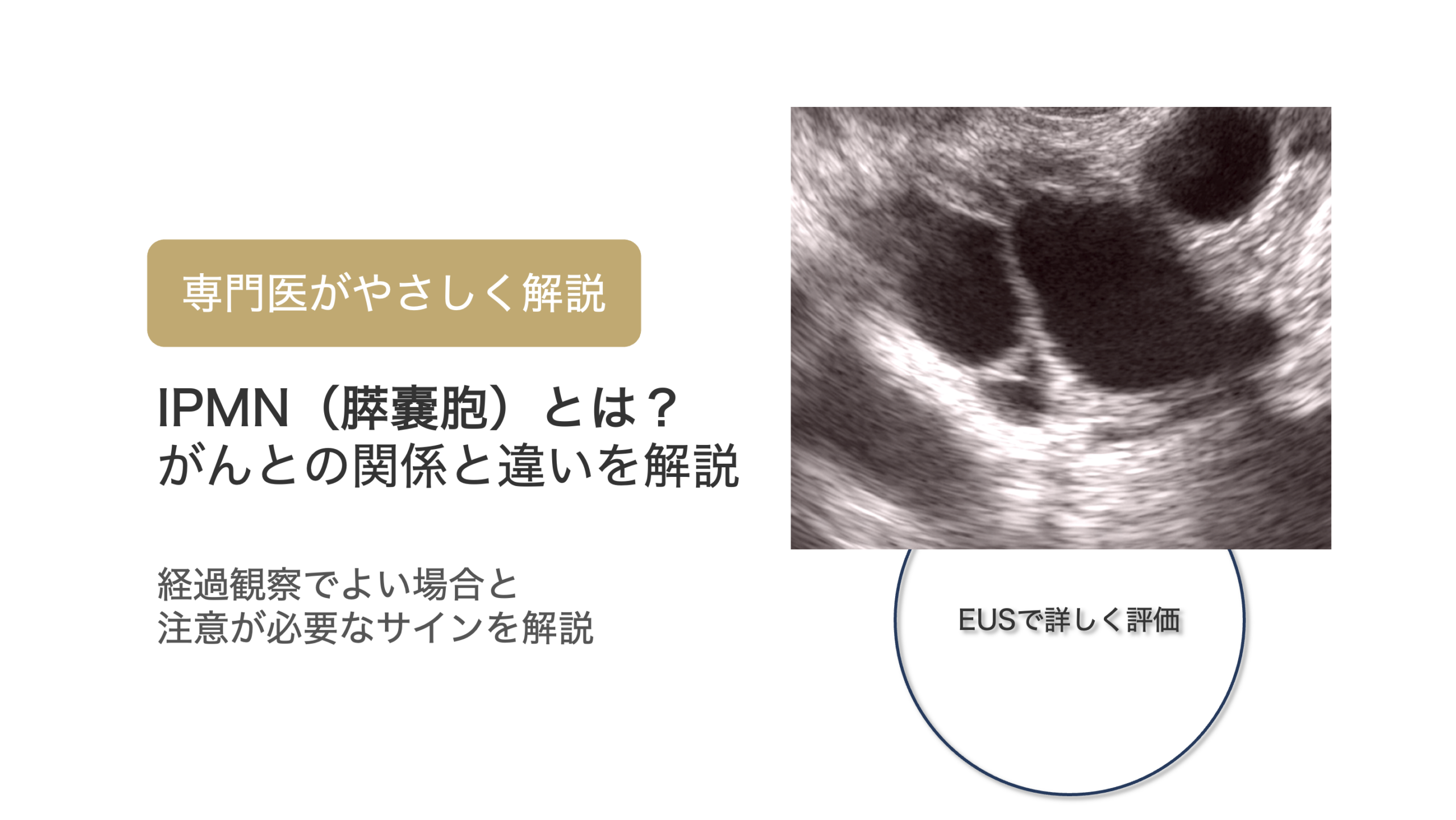 IPMNとは？膵嚢胞との違い・がんとの関係を専門医がわかりやすく解説