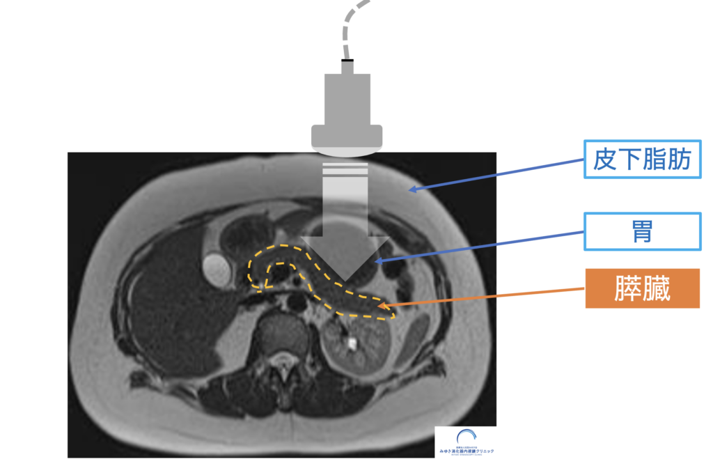 MRI画像で示した膵臓の位置(腹部エコーでは胃や皮下脂肪の奥にあり見えにくい)