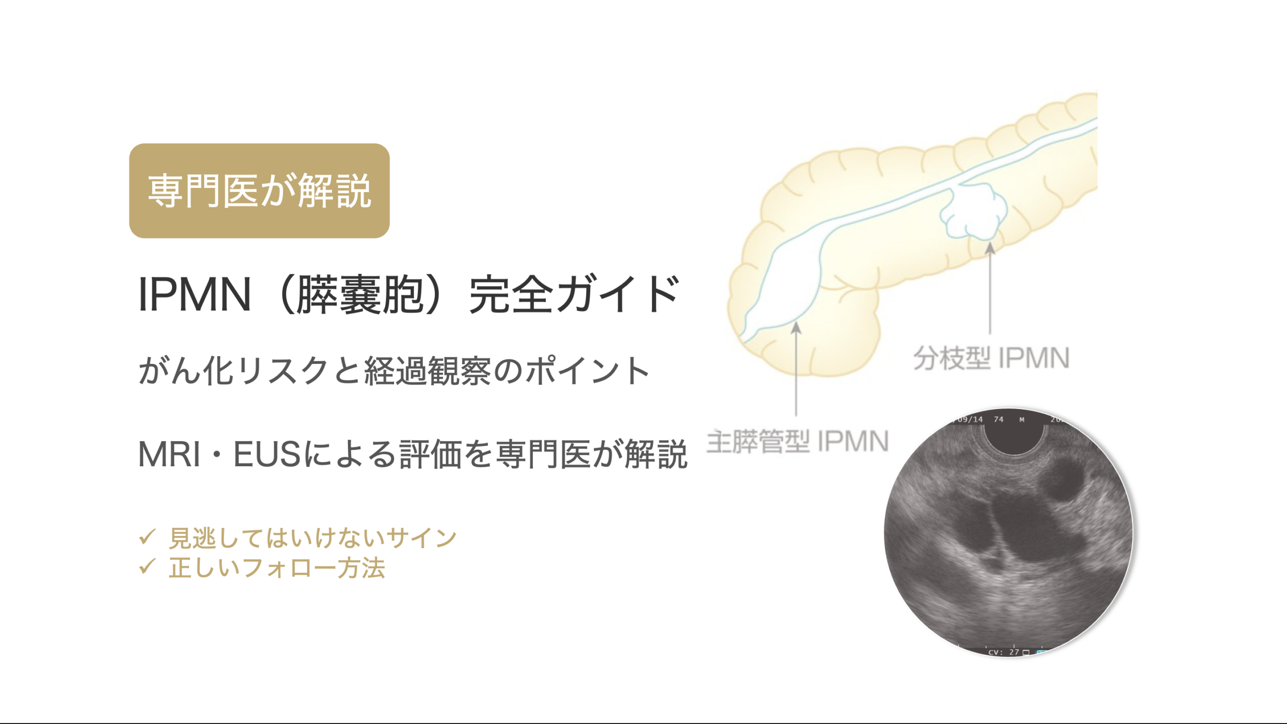 IPMN（膵管内乳頭粘液性腫瘍）完全ガイド｜経過観察・検査・手術の考え方を専門医が解説