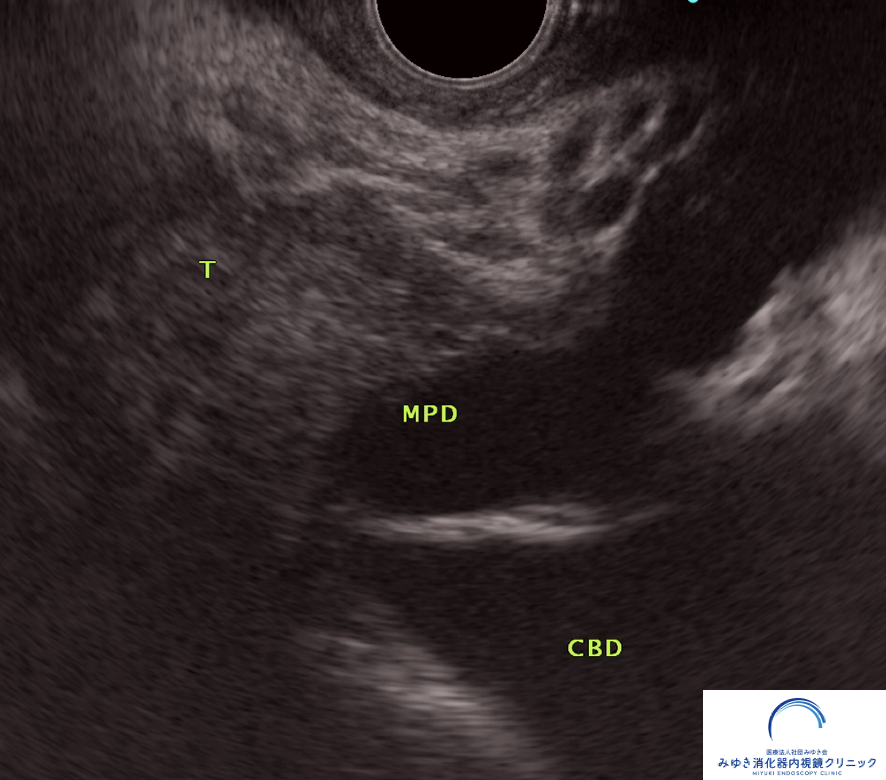 同一症例の膵がん(膵臓がん)による膵管拡張を示したEUS画像|MPD・CBDの拡張所見