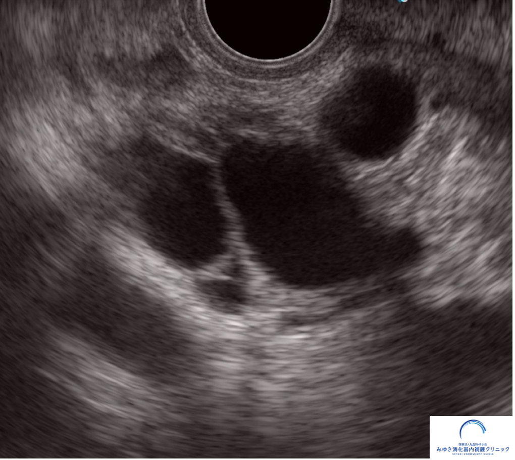 IPMNとは？膵嚢胞との違い・がんとの関係を専門医がわかりやすく解説