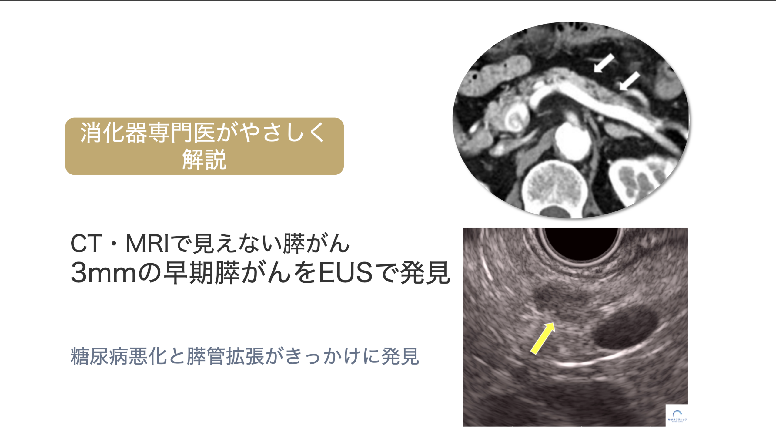 【症例】糖尿病悪化をきっかけに発見された極めて早期の膵がん（3mm・ステージIa)｜膵管拡張とEUSの重要性
