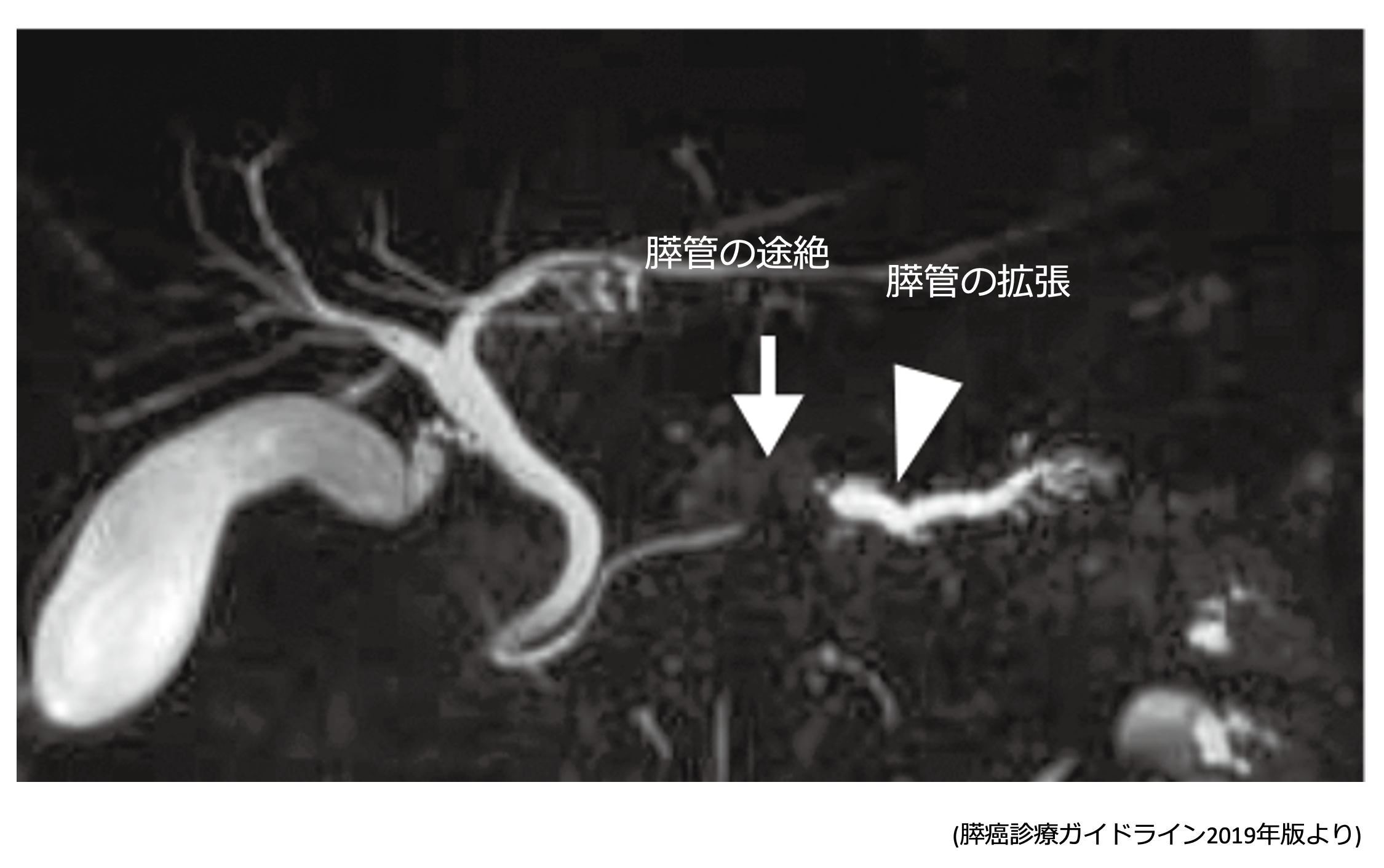 MRIで膵管の狭窄と上流の膵管拡張が確認できる画像