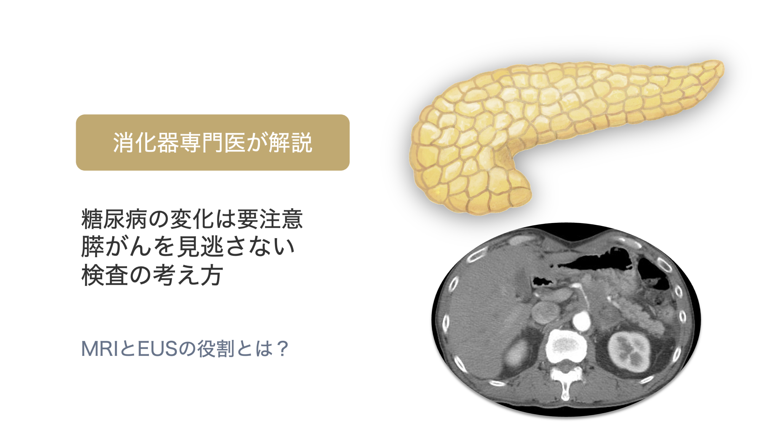 糖尿病が急に悪化した方へ｜膵がんを見逃さないための画像検査の考え方