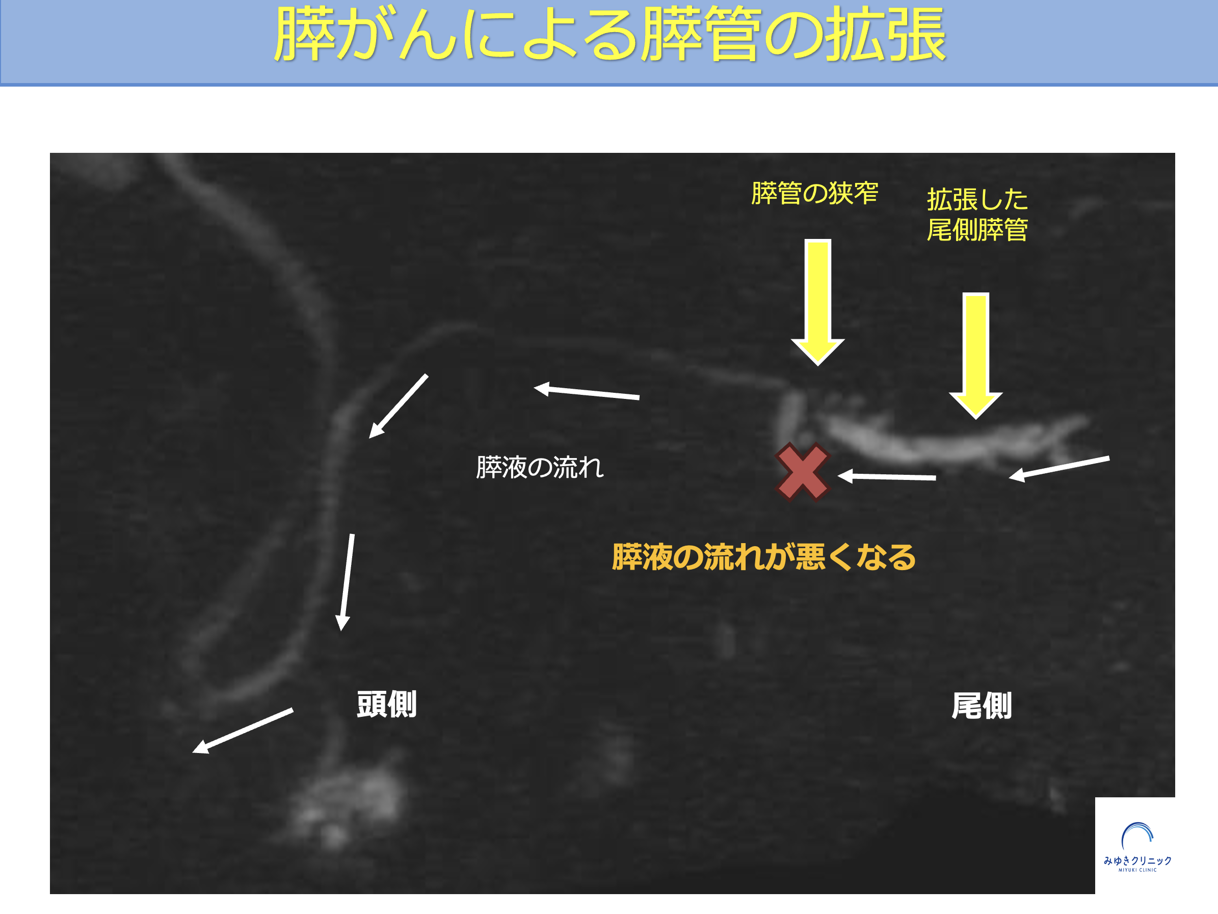 膵がんにより膵管が閉塞し上流側が拡張する模式図