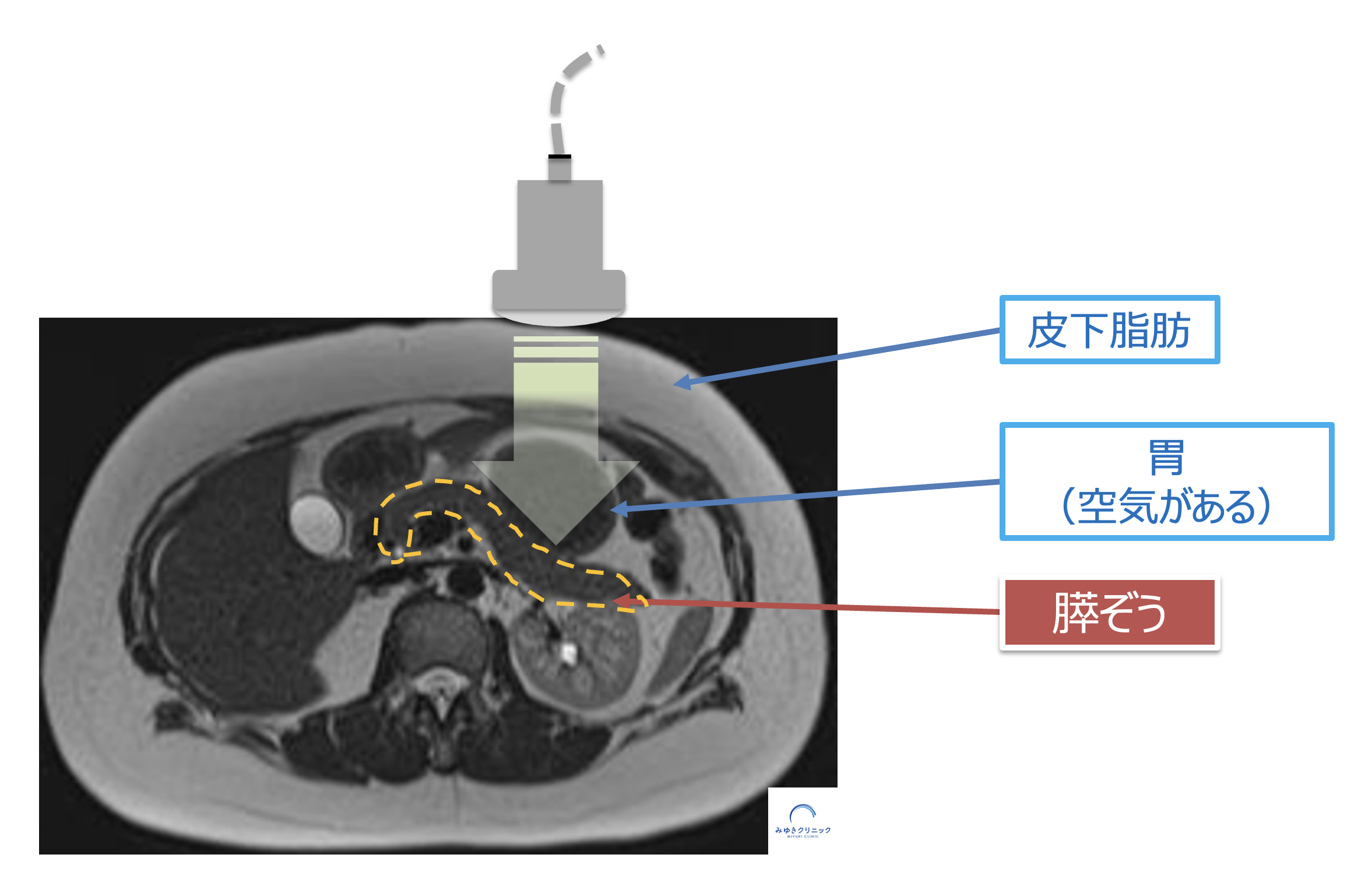 腹部エコーでは膵臓が見えにくい理由