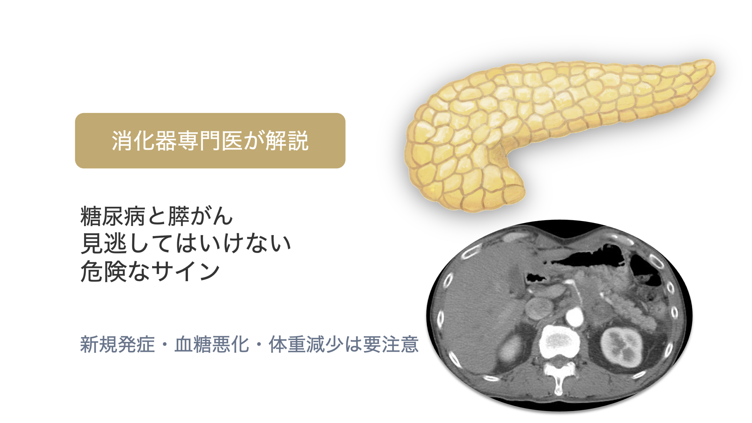 糖尿病が急に悪化した方へ｜膵がんとの関係と注意すべきサイン