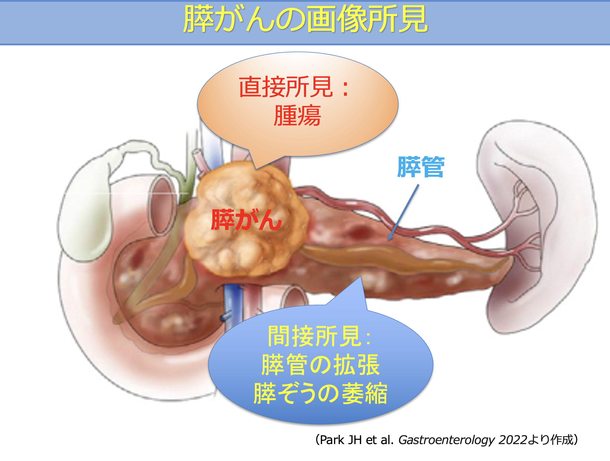 膵がんの直接所見と間接所見（膵管拡張・膵萎縮）の違い