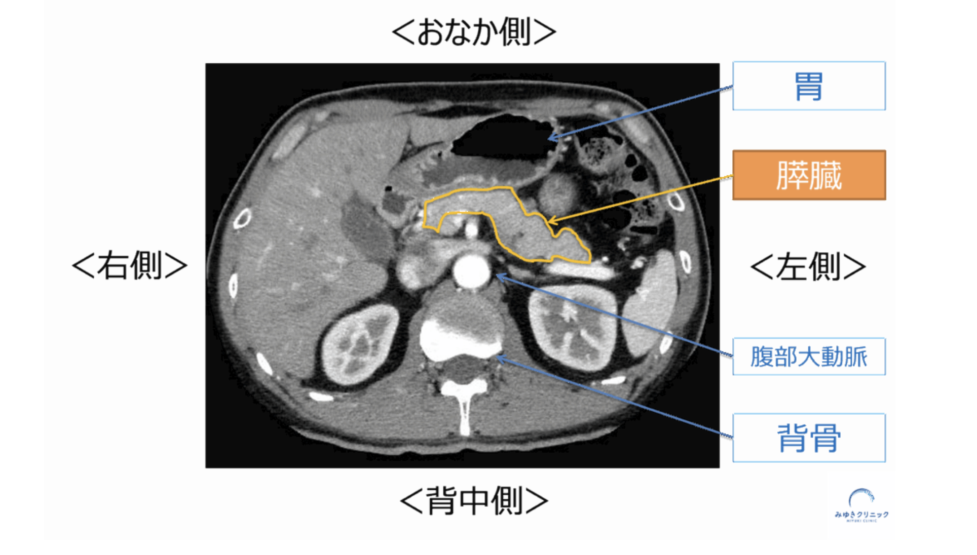 膵がんが初期に症状を出しにくい理由を示した図