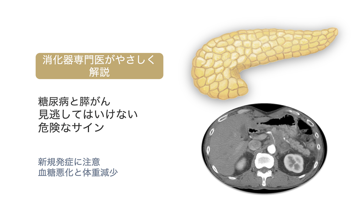 糖尿病が急に悪化した方へ｜膵がんとの関係と注意すべきサイン