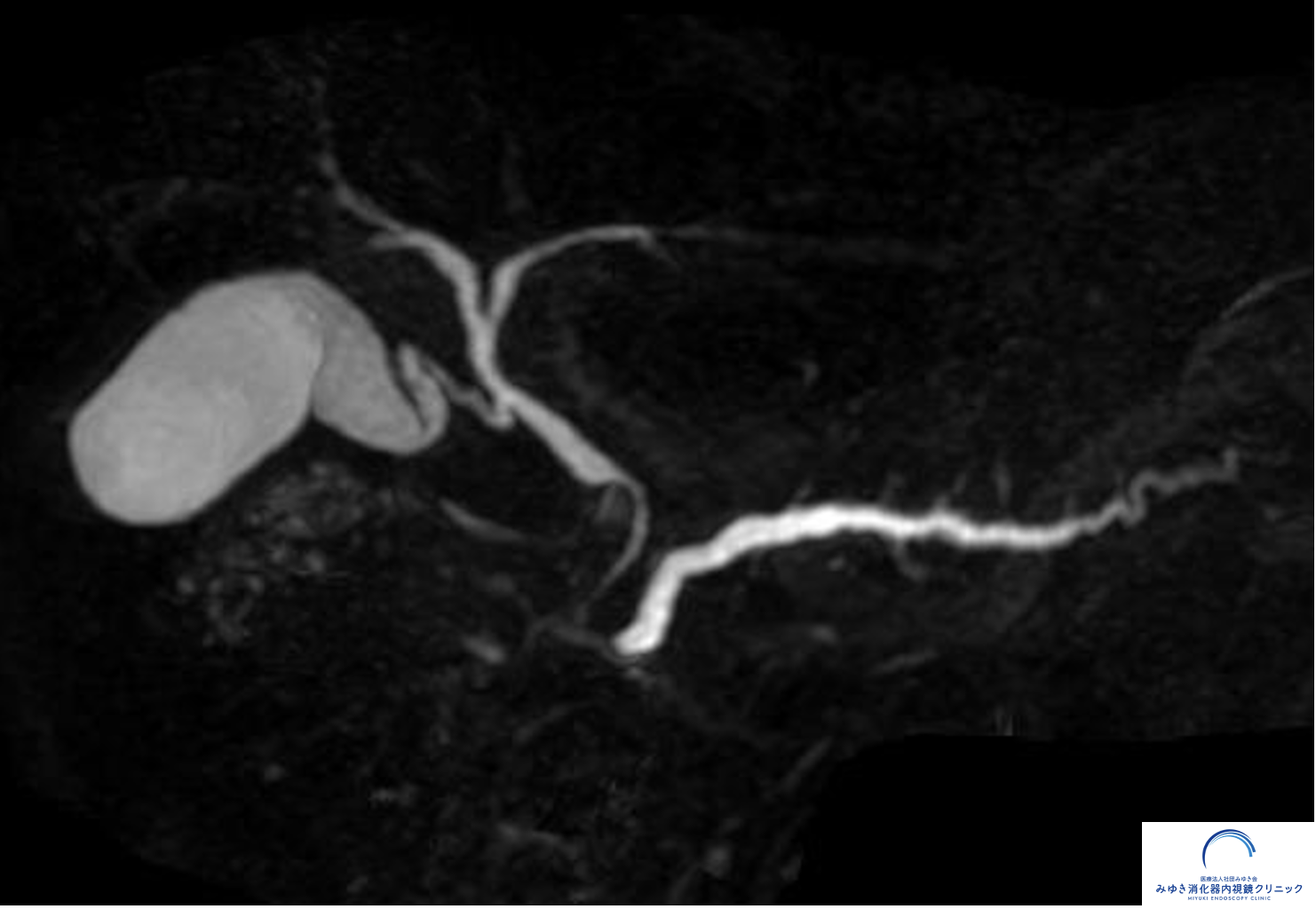 膵管拡張を認めた腹部MRI（MRCP）画像。膵管途絶をきっかけにEUS精査を行った症例