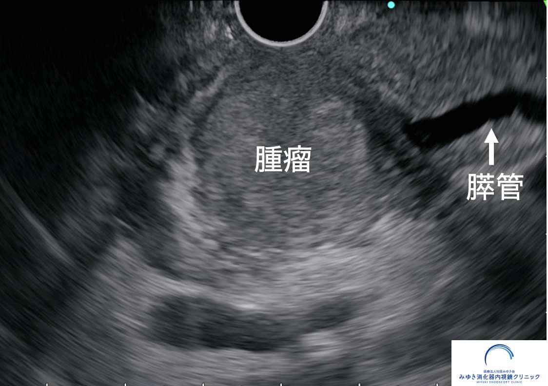 膵管拡張の原因となった膵頭部腫瘤を超音波内視鏡（EUS）で確認した画像