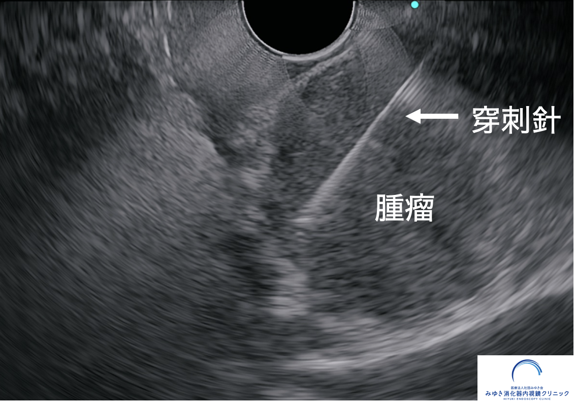 膵頭部腫瘤に対して超音波内視鏡下穿刺吸引法（EUS-FNA）を行っている画像