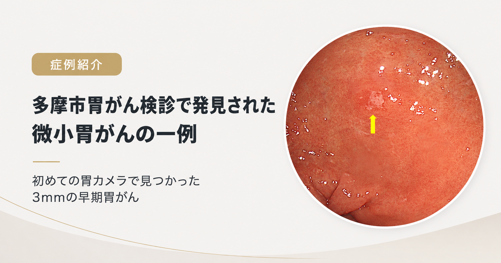 多摩市胃がん検診で発見された微小胃がんの一例