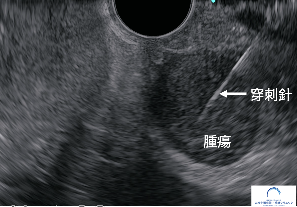 十二指腸腫瘍に対して行ったEUS下穿刺吸引法EUS-FNA