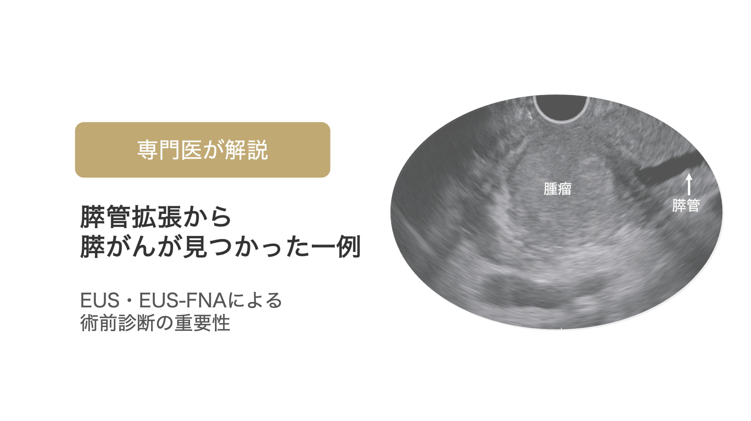 膵管拡張をきっかけに、超音波内視鏡（EUS）で診断された膵がん（未分化型）の一例