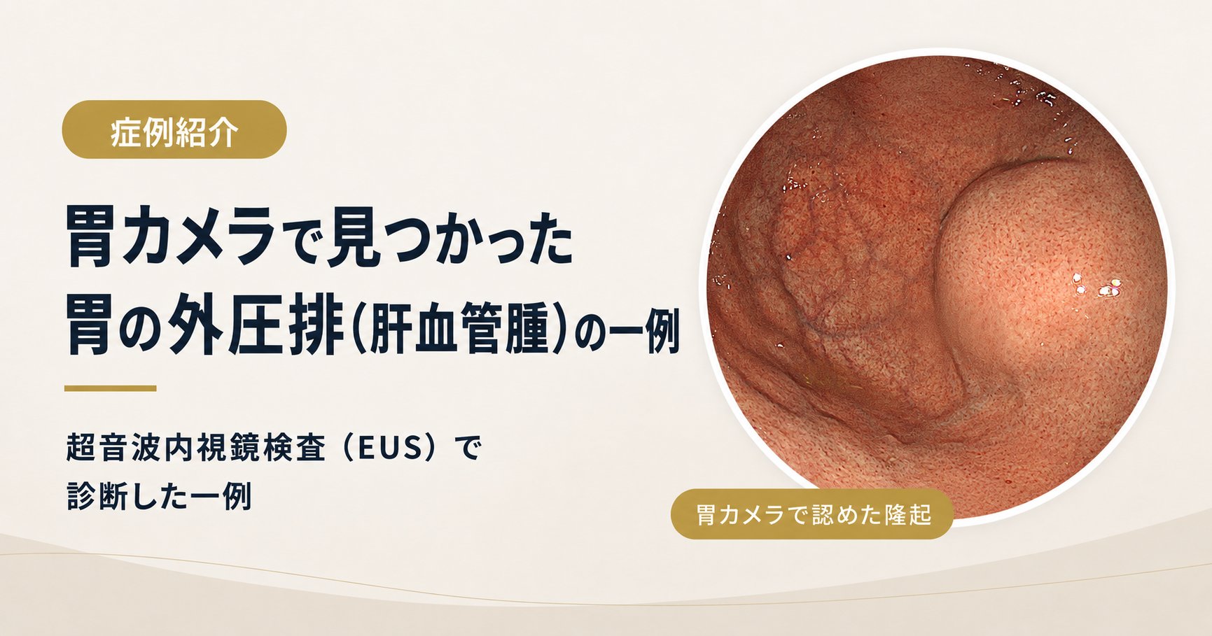 胃粘膜下腫瘍が疑われた肝血管腫の一例｜超音波内視鏡検査（EUS）でわかった胃外圧排