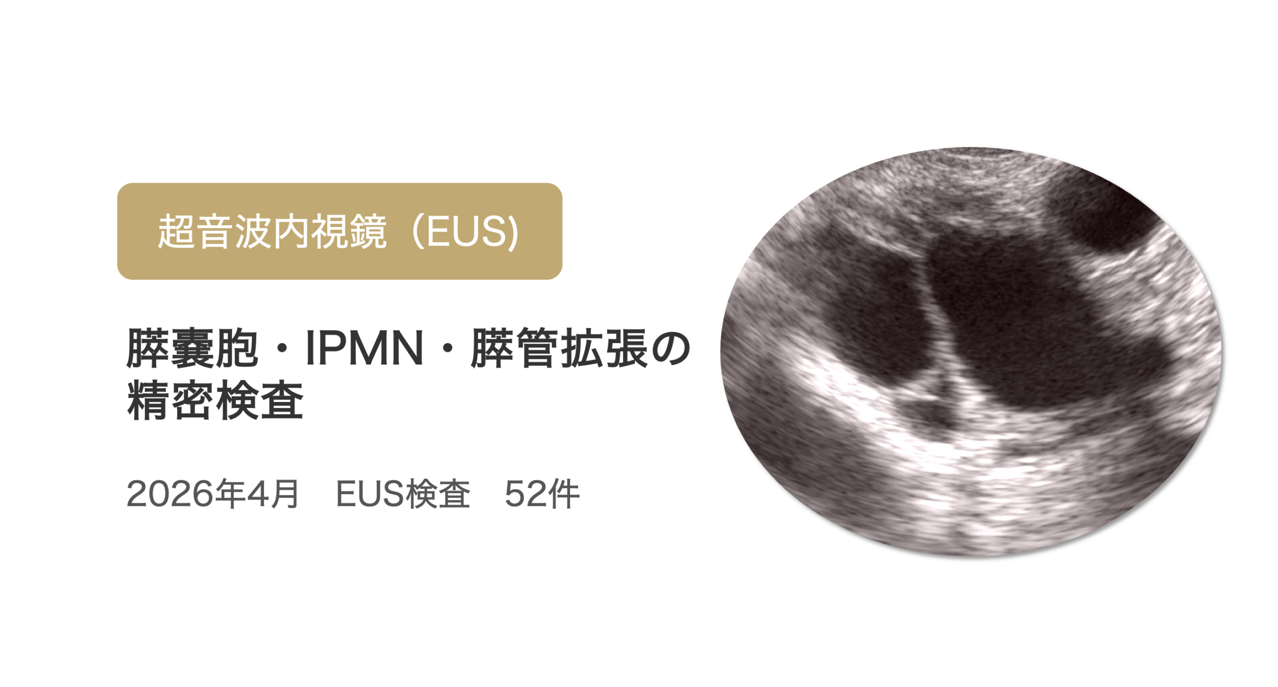 4月も多くの方に超音波内視鏡（EUS）を受けていただきました｜膵嚢胞・IPMNの精密検査について