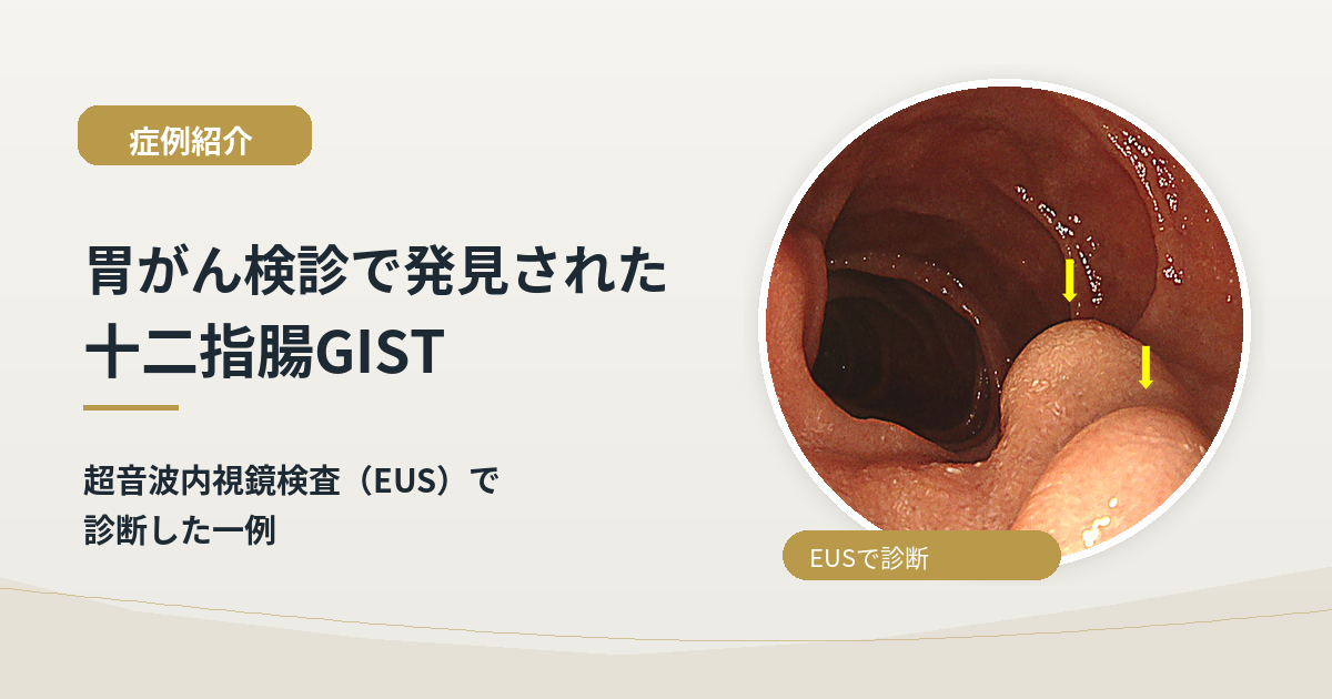 多摩市胃がん検診で見つかった十二指腸GISTの一例｜EUSで診断した症例