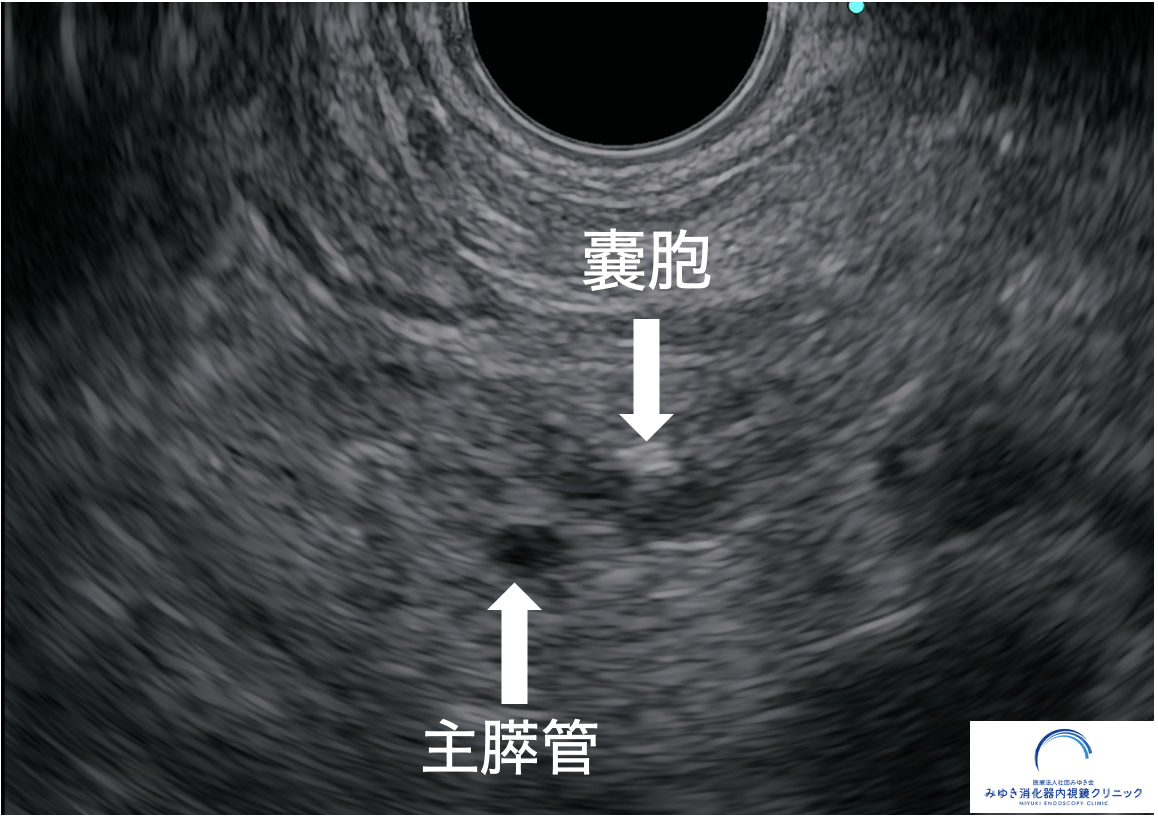 超音波内視鏡検査で確認された膵体部の小さな嚢胞と主膵管
