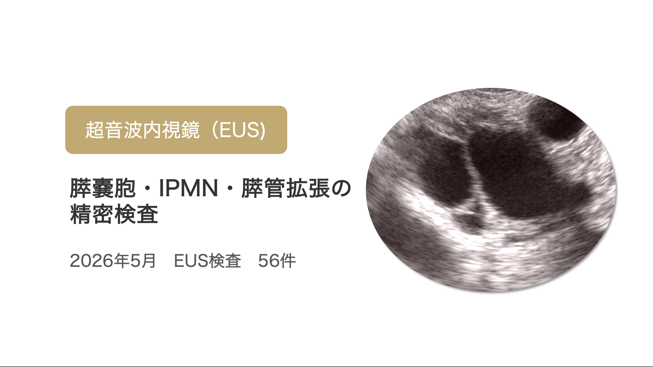 5月の超音波内視鏡（EUS）検査は56件でした｜膵嚢胞・IPMN・膵管拡張の精密検査について