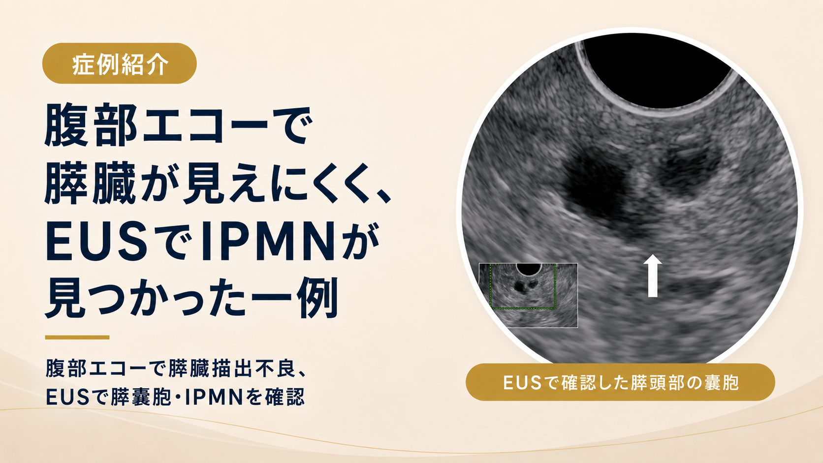 【症例】腹部エコーで膵臓が見えにくく、超音波内視鏡検査でIPMNが見つかった一例