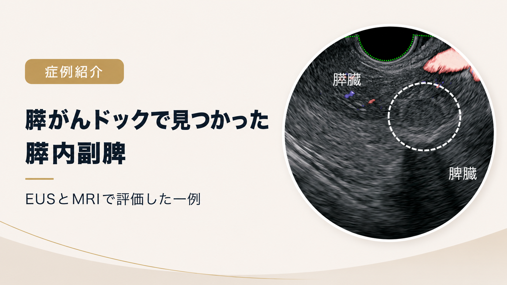 【症例】膵がんドックで見つかった膵内副脾