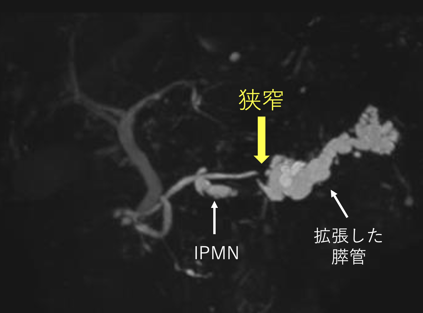 MRI（MRCP）で認めた膵管狭窄と尾側膵管拡張。IPMNとは離れた部位に膵管狭窄を認める