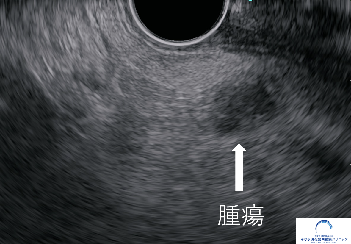 超音波内視鏡検査（EUS）で認めた7mmの膵がん
