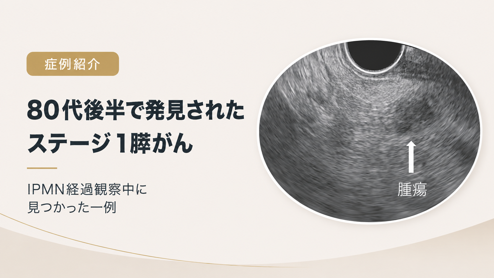 【症例】80代後半で発見されたステージ1膵がん― IPMN経過観察中に見つかった7mmの膵がん