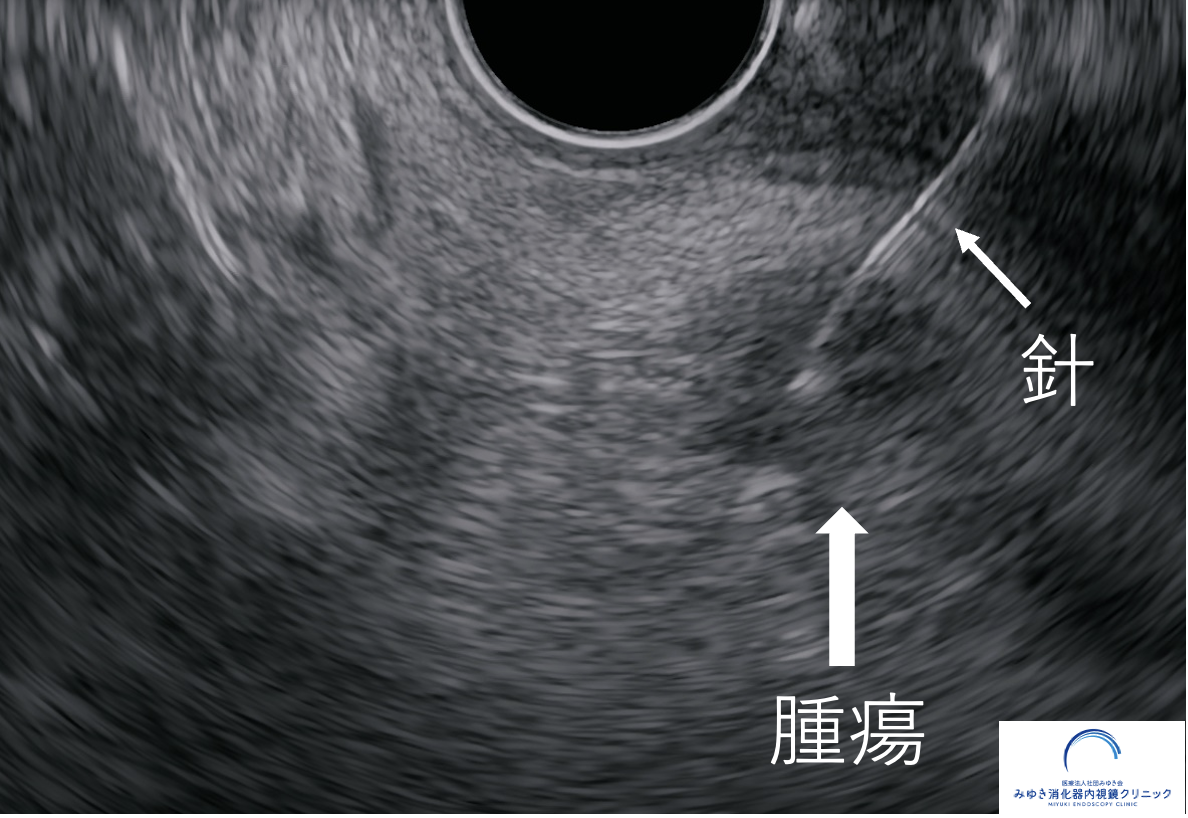 超音波内視鏡下穿刺生検（EUS-FNB）で7mmの膵腫瘍を穿刺している画像