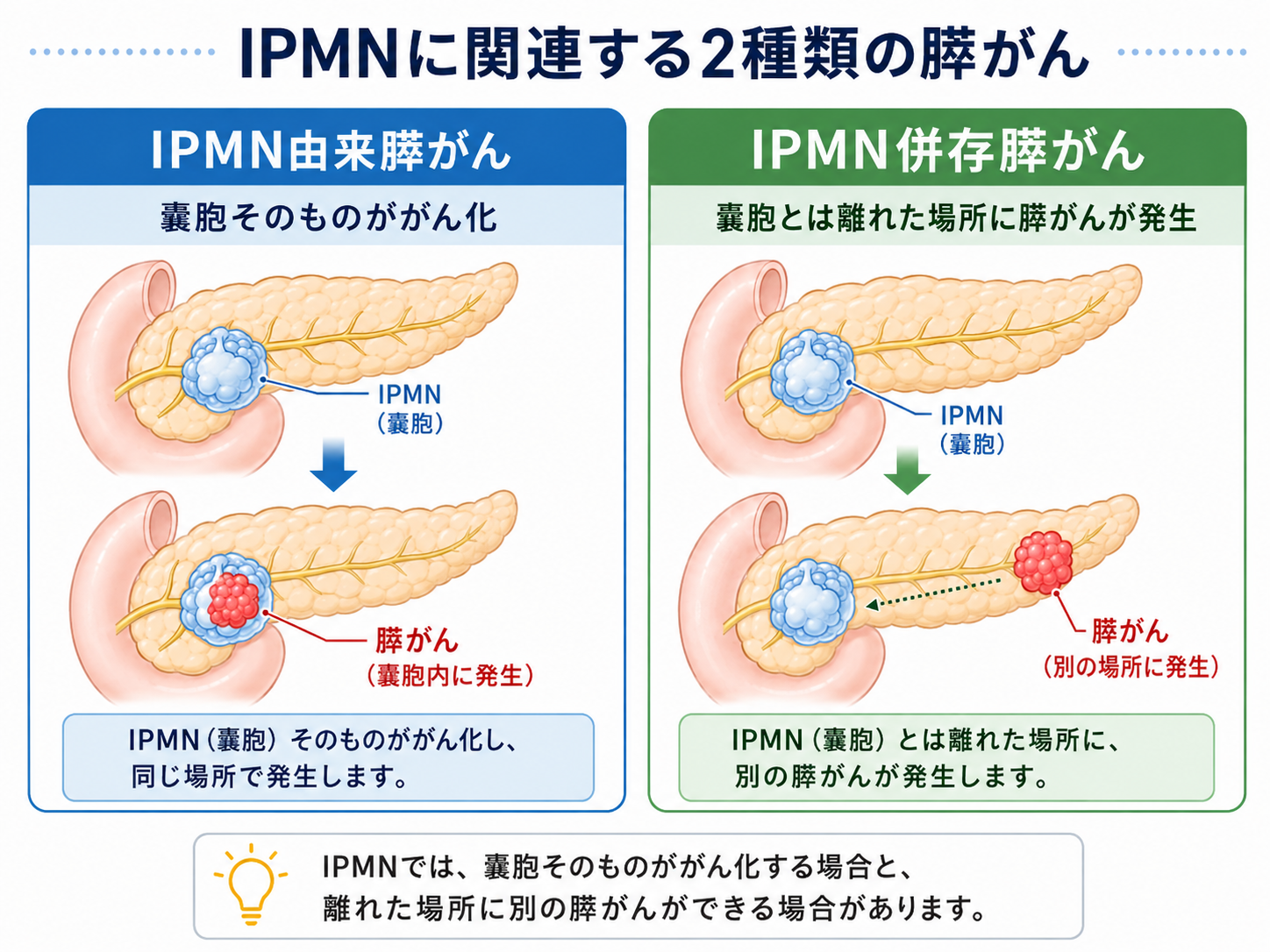 IPMN由来膵がんとIPMN併存膵がんの違いを示したイラスト